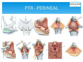 PTR - PERINEAL

 