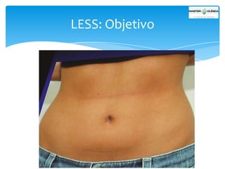 LESS: Objetivo

 