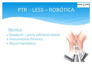 PTR - LESS – ROBÓTICA

Técnica
Quadport + porta adicional lateral
 Instrumentos flexíveis
 Bisturí harmônico


 