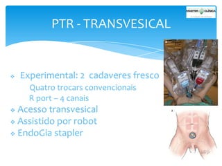 PTR - TRANSVESICAL



Experimental: 2 cadaveres fresco
Quatro trocars convencionais
R port – 4 canais

Acesso transvesical
 Assistido por robot
 EndoGia stapler


 