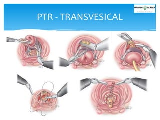 PTR - TRANSVESICAL

 