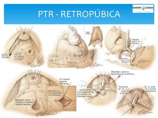 PTR - RETROPÚBICA

 
