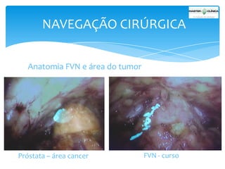 NAVEGAÇÃO CIRÚRGICA
Anatomia FVN e área do tumor

Próstata – área cancer

FVN - curso

 
