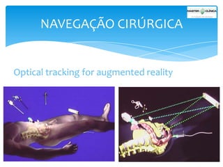 NAVEGAÇÃO CIRÚRGICA

Optical tracking for augmented reality

 