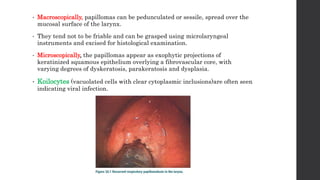 • Macroscopically, papillomas can be pedunculated or sessile, spread over the
mucosal surface of the larynx.
• They tend not to be friable and can be grasped using microlaryngeal
instruments and excised for histological examination.
• Microscopically, the papillomas appear as exophytic projections of
keratinized squamous epithelium overlying a fibrovascular core, with
varying degrees of dyskeratosis, parakeratosis and dysplasia.
• Koilocytes (vacuolated cells with clear cytoplasmic inclusions)are often seen
indicating viral infection.
 