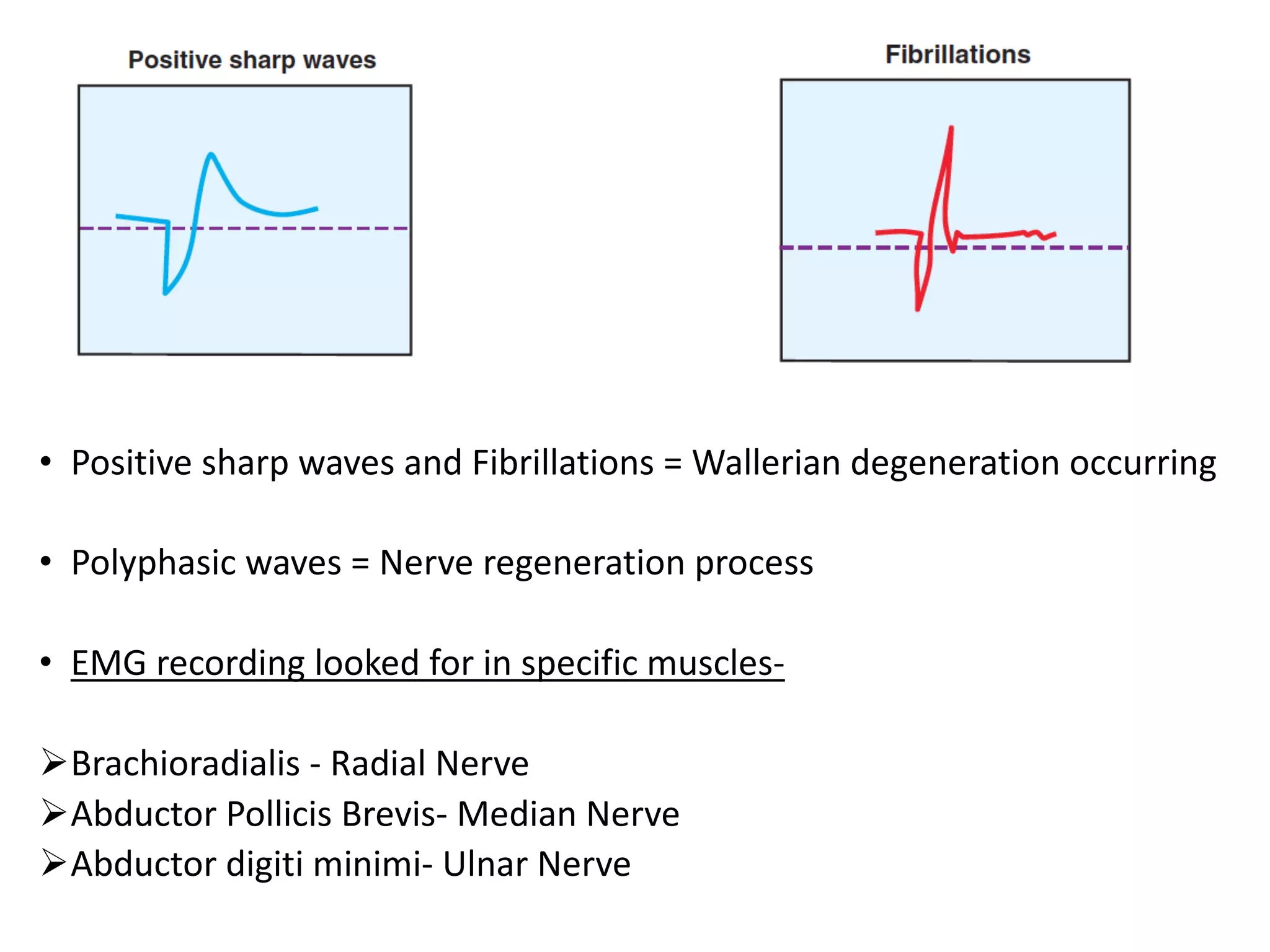• Positive	sharp	waves	and	Fibrillations	=	Wallerian	degeneration	occurring	
• Polyphasic waves	=	Nerve	regeneration	process
• EMG	recording	looked	for	in	specific	muscles-
ØBrachioradialis - Radial	Nerve
ØAbductor	Pollicis Brevis- Median	Nerve
ØAbductor	digiti minimi- Ulnar	Nerve
 