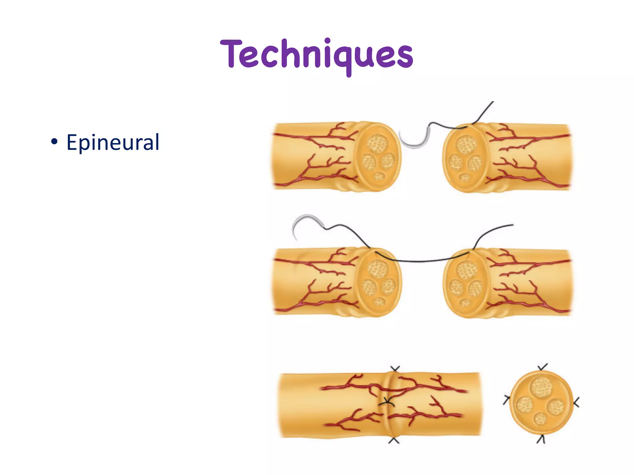 • Epineural
Techniques
 