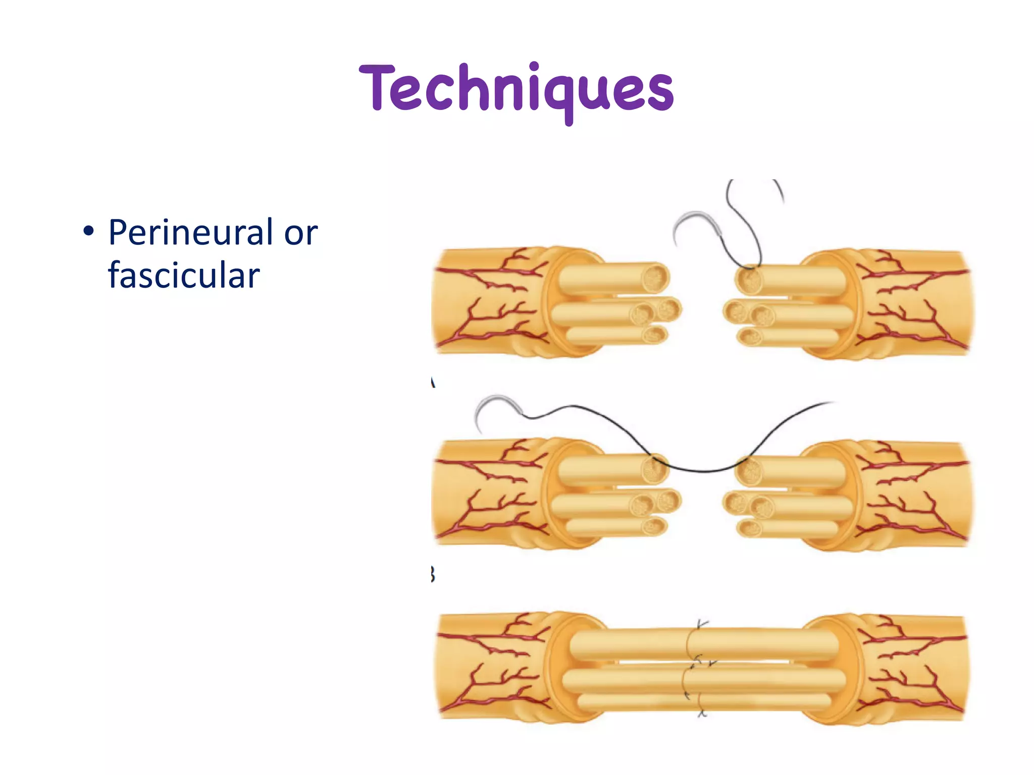 • Perineural or	
fascicular
Techniques
 