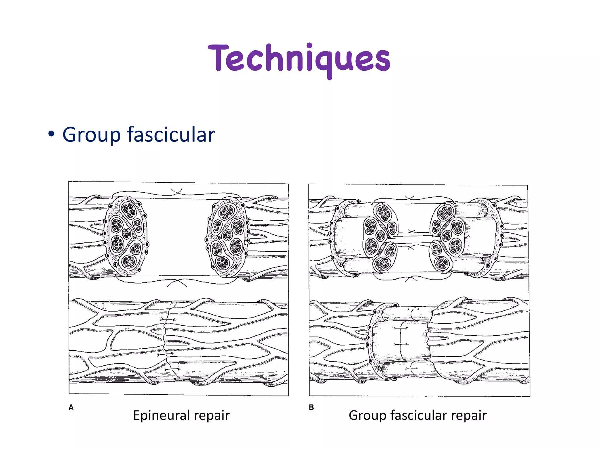 • Group	fascicular
Techniques
Epineural repair Group	fascicular	repair
 