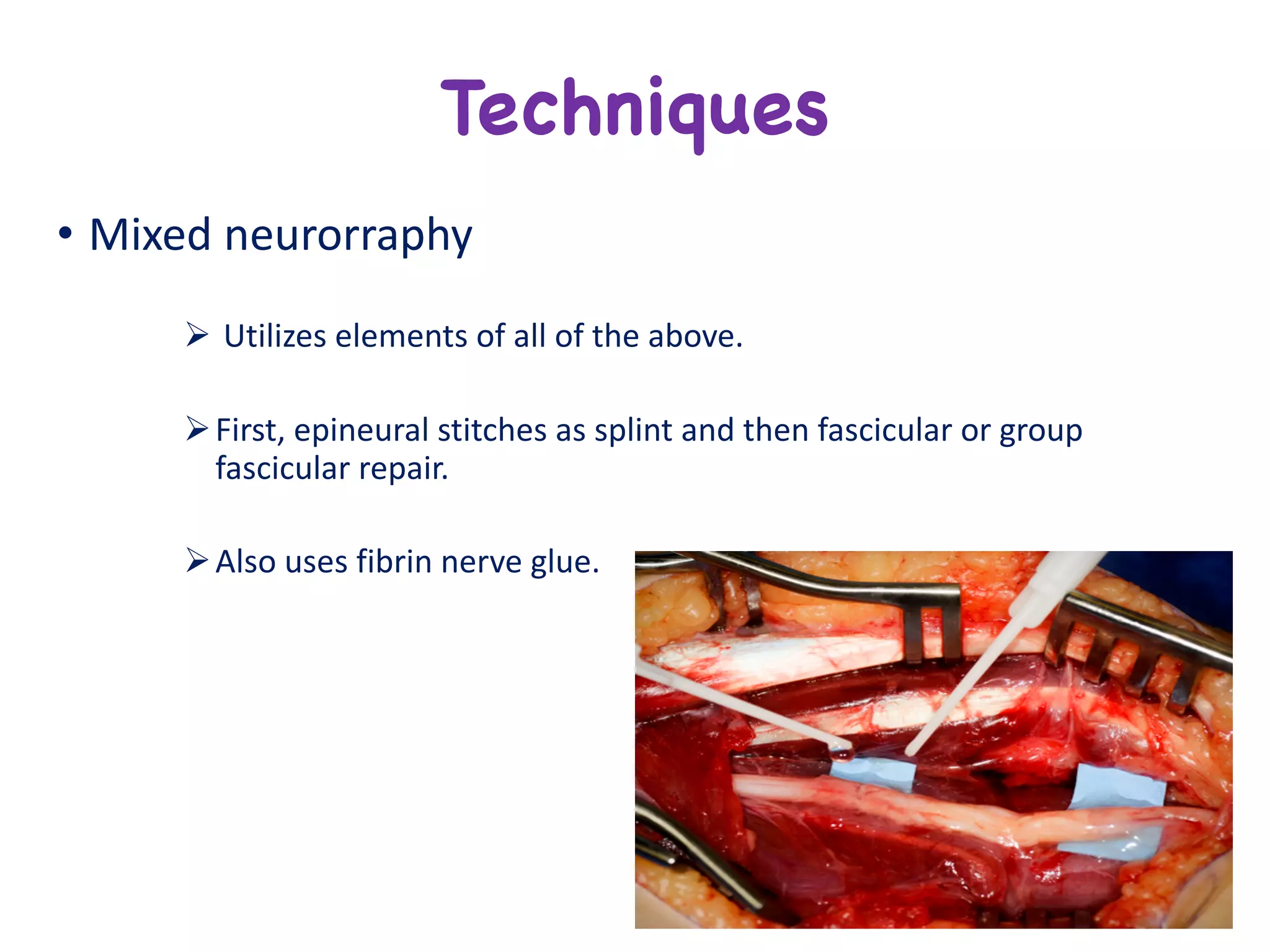 • Mixed	neurorraphy
Ø Utilizes	elements	of	all	of	the	above.
ØFirst,	epineural stitches	as	splint	and	then	fascicular	or	group	
fascicular	repair.
ØAlso	uses	fibrin	nerve	glue.
Techniques
 
