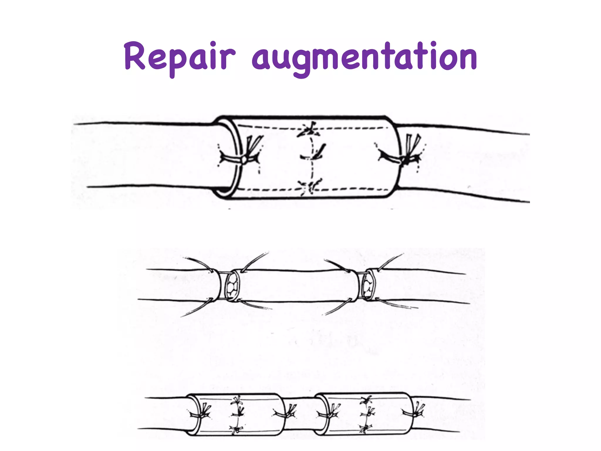 Repair augmentation
 