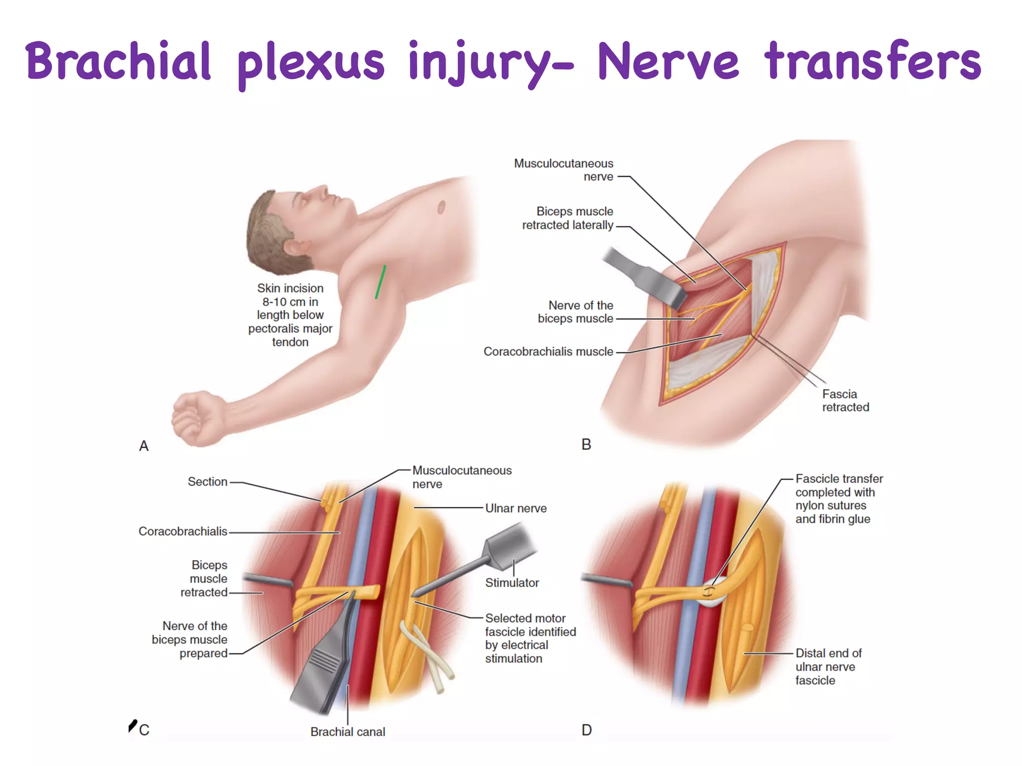 Brachial plexus injury- Nerve transfers
 