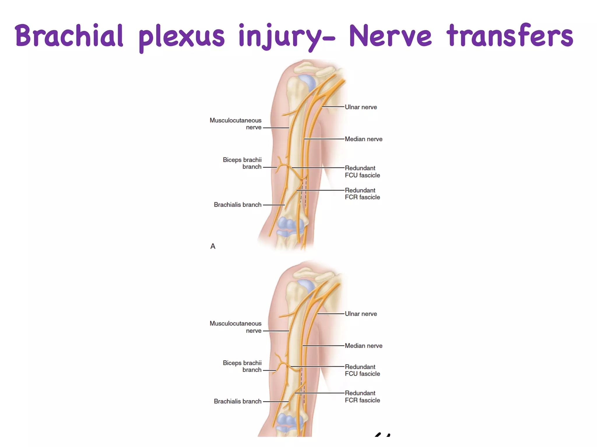 Brachial plexus injury- Nerve transfers
 