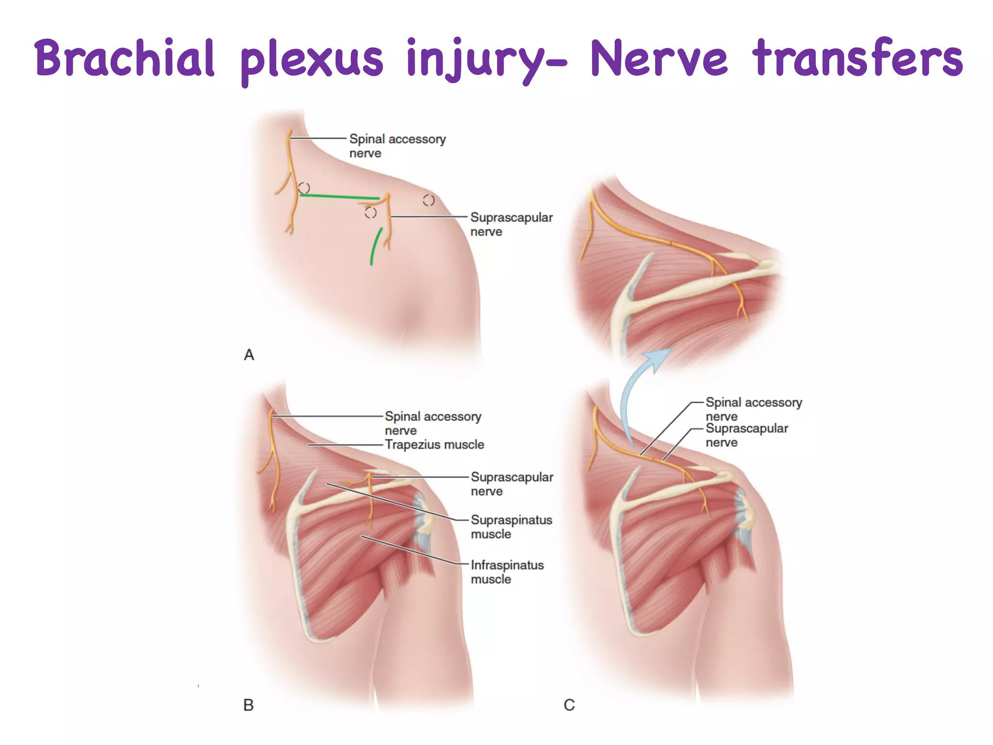 Brachial plexus injury- Nerve transfers
 