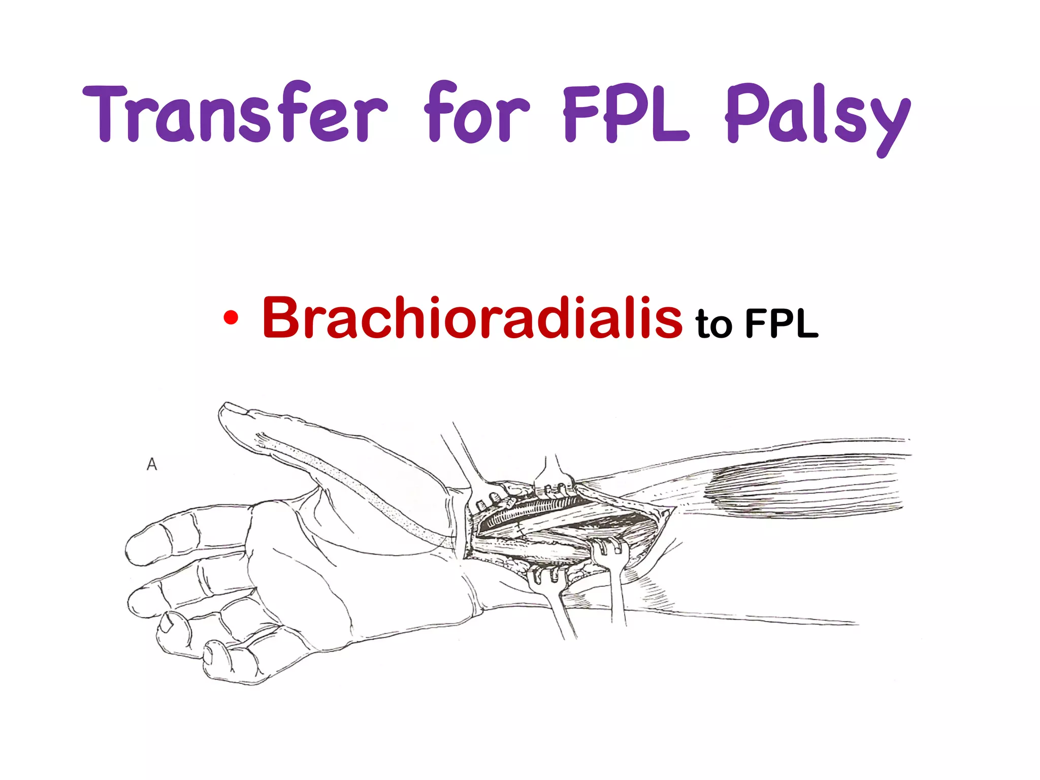 Transfer for FPL Palsy
• Brachioradialis to FPL
 