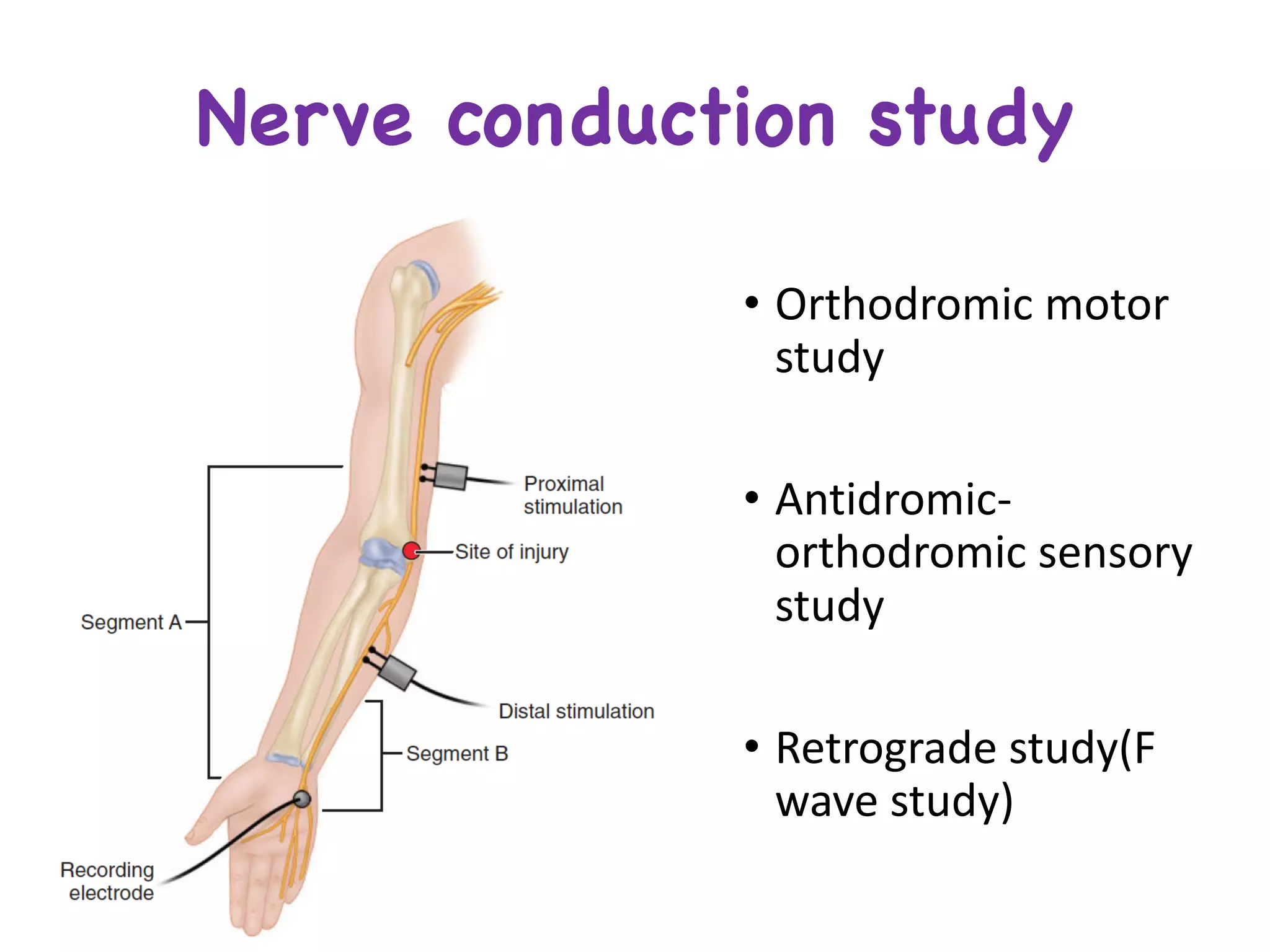 Nerve conduction study
• Orthodromic motor	
study
• Antidromic-
orthodromic sensory	
study	
• Retrograde	study(F	
wave	study)
 