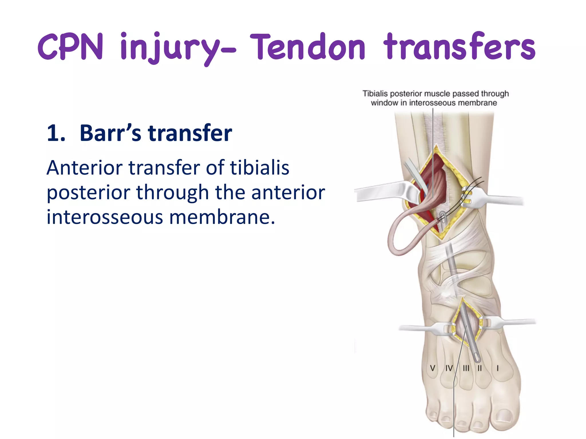 CPN injury- Tendon transfers
1. Barr’s	transfer	
Anterior	transfer	of	tibialis	
posterior	through	the	anterior	
interosseous	membrane.
 