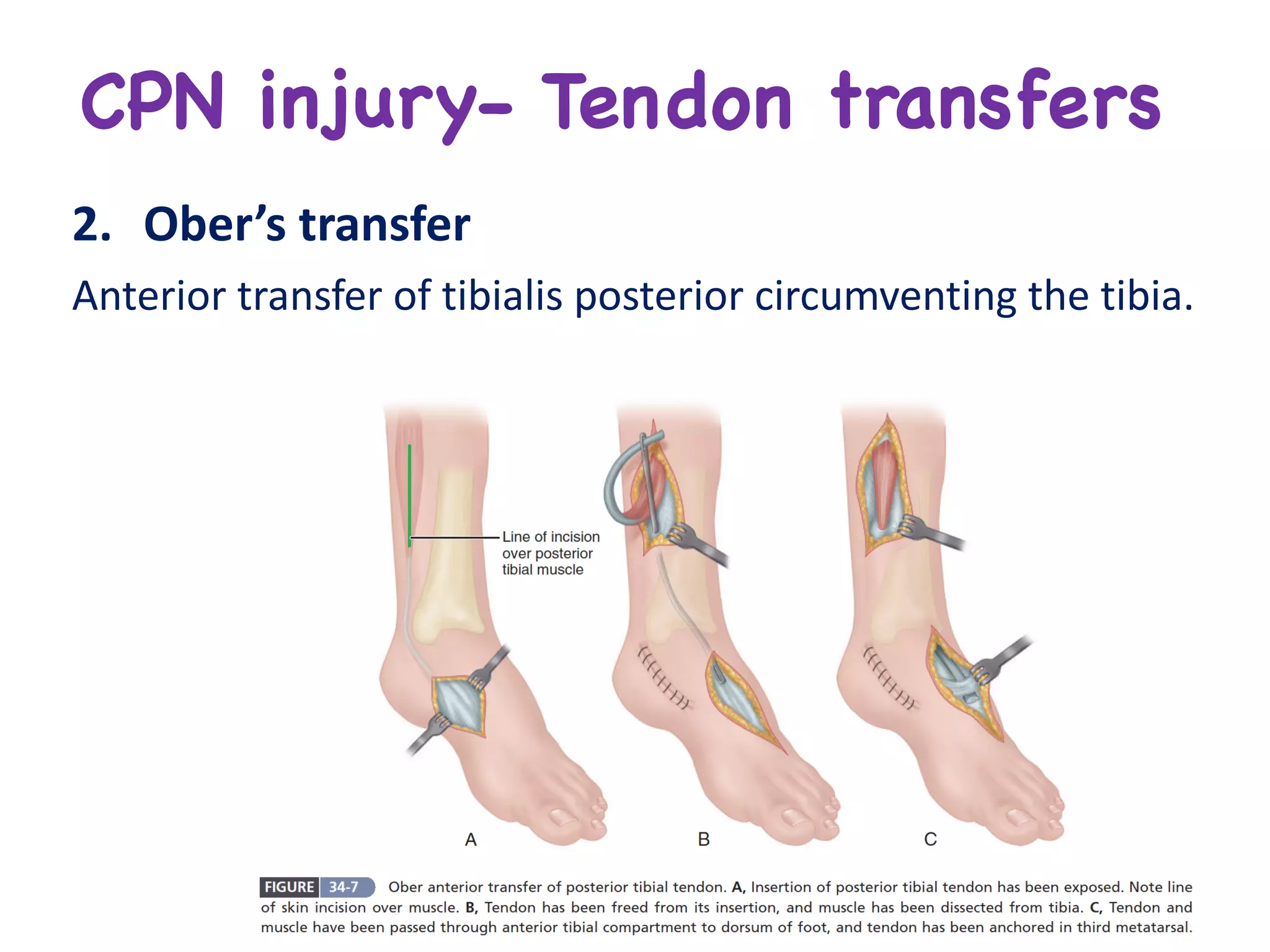 CPN injury- Tendon transfers
2. Ober’s	transfer	
Anterior	transfer	of	tibialis	posterior	circumventing	the	tibia.
 