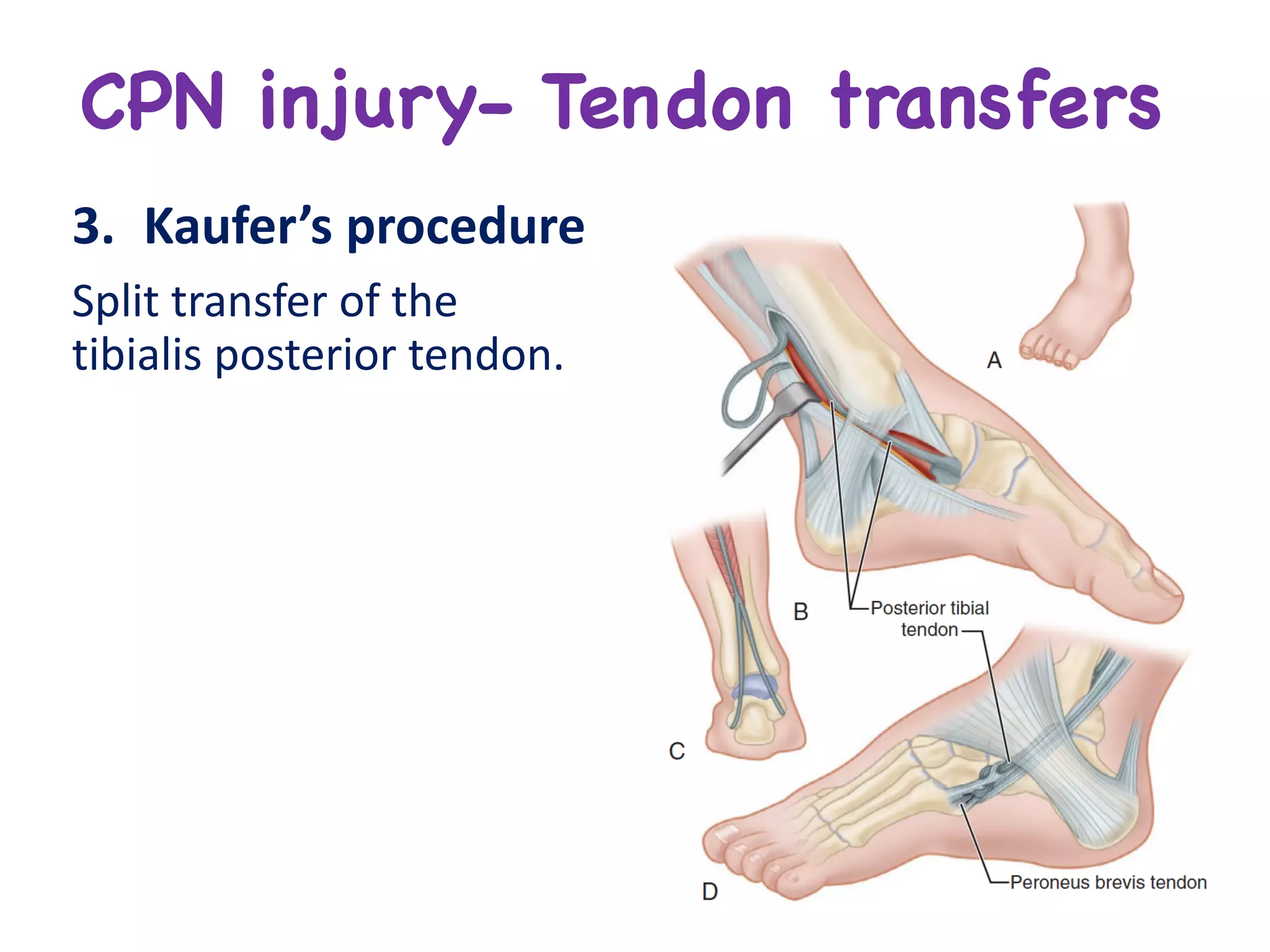 CPN injury- Tendon transfers
3. Kaufer’s procedure
Split	transfer	of	the	
tibialis	posterior	tendon.
 