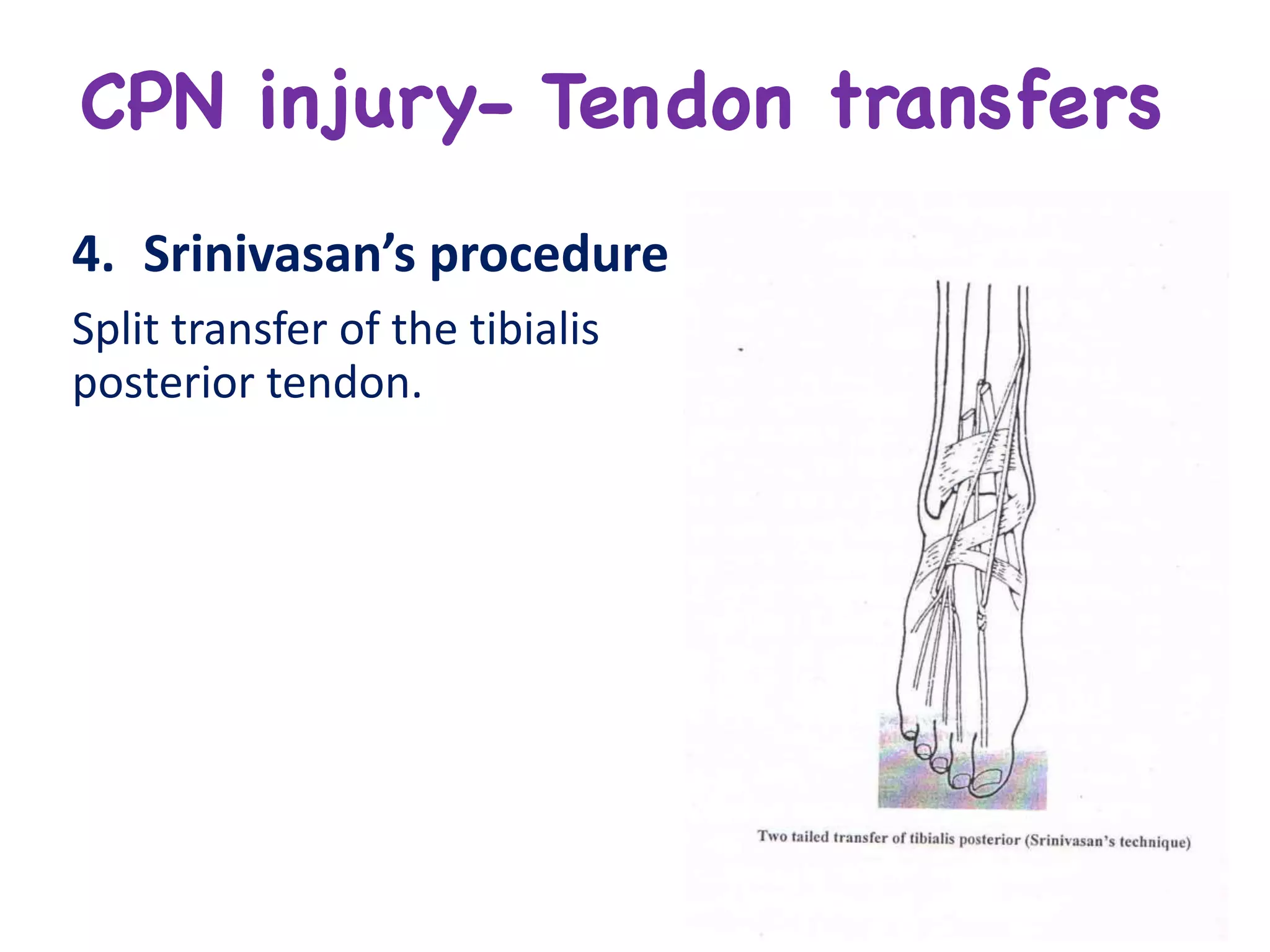 CPN injury- Tendon transfers
4. Srinivasan’s	procedure
Split	transfer	of	the	tibialis	
posterior	tendon.
 