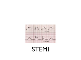 STEMI
 