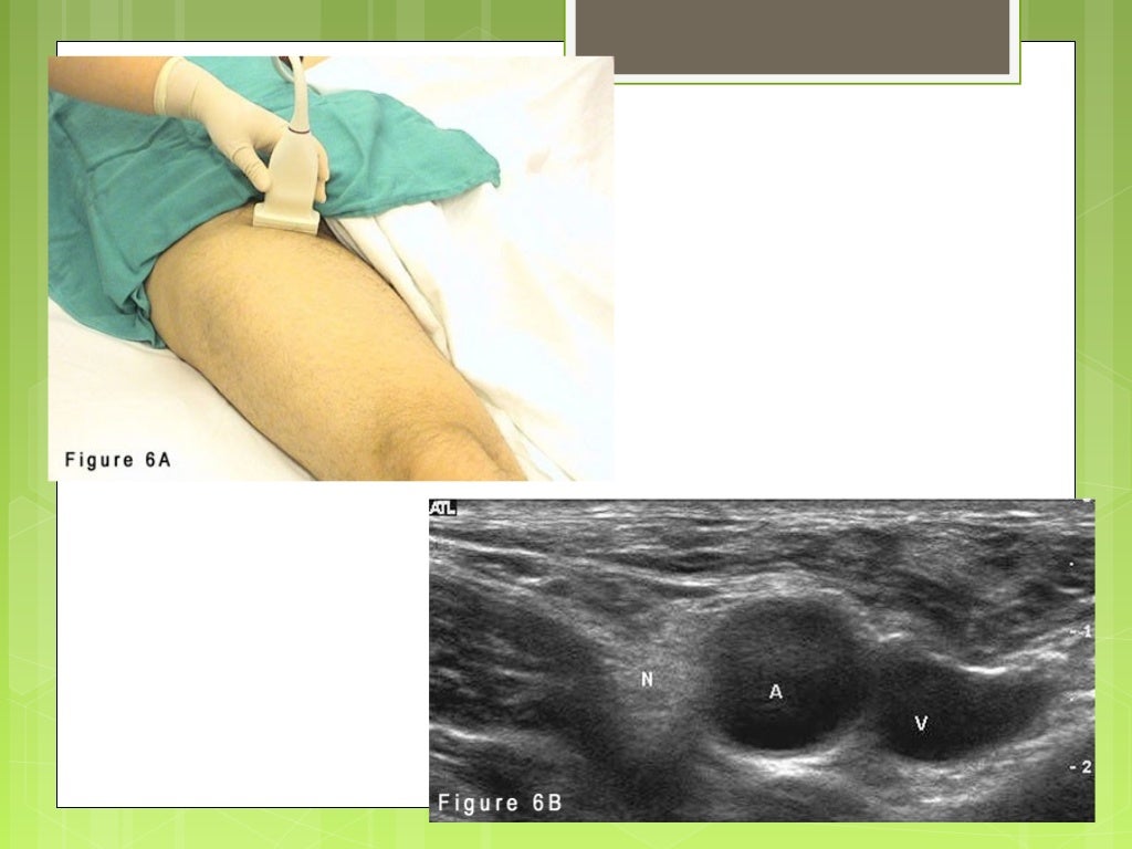 Ultrasound Guided Peripheral Nerve Blocks