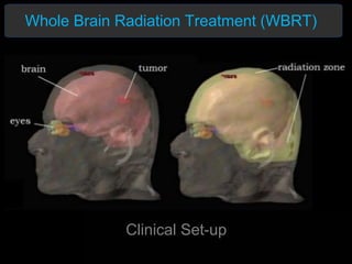 Clinical Set-up
Whole Brain Radiation Treatment (WBRT)
 