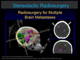 http://radonc.ucsd.edu/patient-info/treatment-
options/procedures/PublishingImages/Radiosurgery_for_Multiple_Brain_Metastasis.jpg
Stereotactic Radiosurgery
 