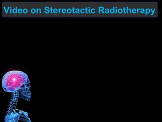 Video on Stereotactic Radiotherapy
 