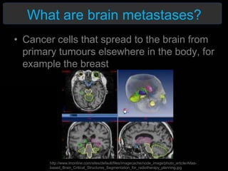 What are brain metastases?
• Cancer cells that spread to the brain from
primary tumours elsewhere in the body, for
example the breast
http://www.itnonline.com/sites/default/files/imagecache/node_image/photo_article/Atlas-
based_Brain_Critical_Structures_Segmentation_for_radiotherapy_planning.jpg
 
