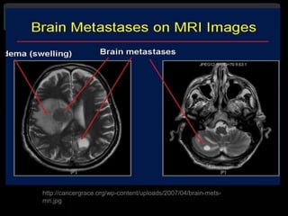 http://cancergrace.org/wp-content/uploads/2007/04/brain-mets-
mri.jpg
 