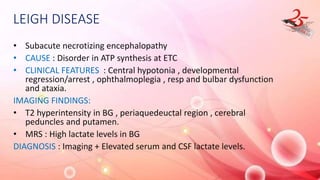 LEIGH DISEASE
• Subacute necrotizing encephalopathy
• CAUSE : Disorder in ATP synthesis at ETC
• CLINICAL FEATURES : Central hypotonia , developmental
regression/arrest , ophthalmoplegia , resp and bulbar dysfunction
and ataxia.
IMAGING FINDINGS:
• T2 hyperintensity in BG , periaquedeuctal region , cerebral
peduncles and putamen.
• MRS : High lactate levels in BG
DIAGNOSIS : Imaging + Elevated serum and CSF lactate levels.
 
