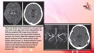 Figure 19. Basilar artery occlusion in a 61-year-old
man with ocular signs and severe obtundation. (a)
Diffusionweighted MR image shows bilateral
hyperintense areas in the paramedian thalamus
(arrows). (b) Timeof- flight MR angiogram clearly
depicts occlusion of the rostral portion of the
basilar artery (arrow). (c, d) Noncontrast CT scans
obtained 3 days later show bilateral subacute
infarcts of the thalamus (arrows in c) and an
infarct in the right cerebellar hemisphere
(arrow in d).
 
