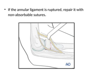 Anular Repad journal RADIAL HEAD FRACTURE REPLACEMENT VS EXCISION | PPTX
