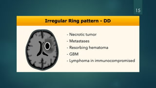 Cns Pattern Enhancement patterns in different cns diseases | PPTX