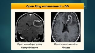 Cns Pattern Enhancement patterns in different cns diseases | PPTX