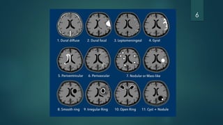 Basic Cns Pattern Enhancement patterns in different cns diseases | PPTX