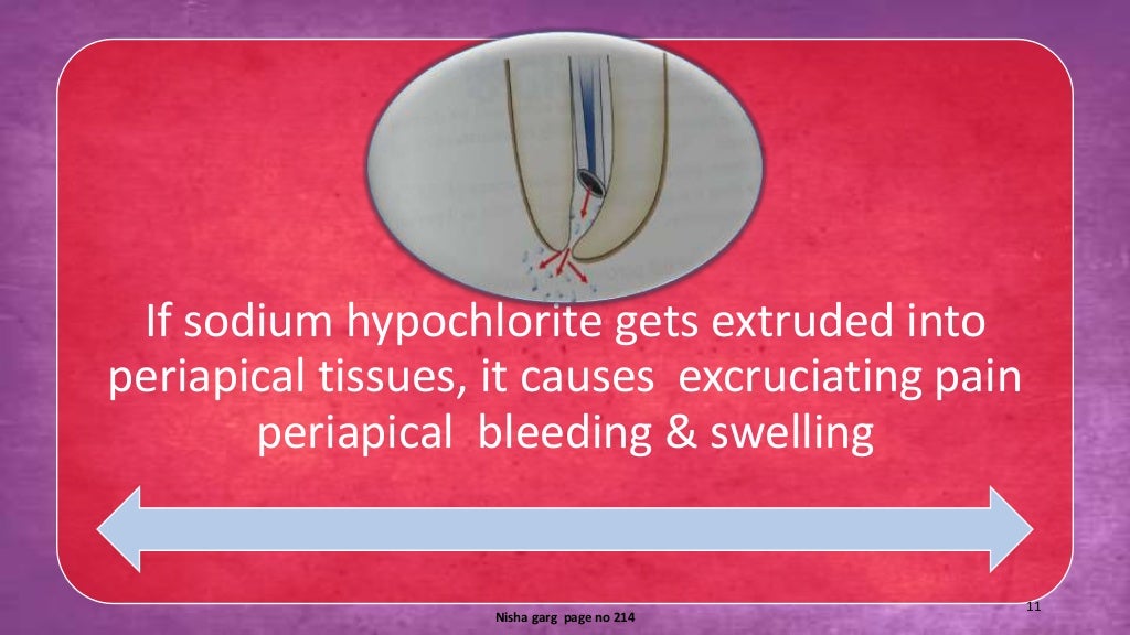 Sodium hypochlorite and its use as an endodontic irrigant Australian