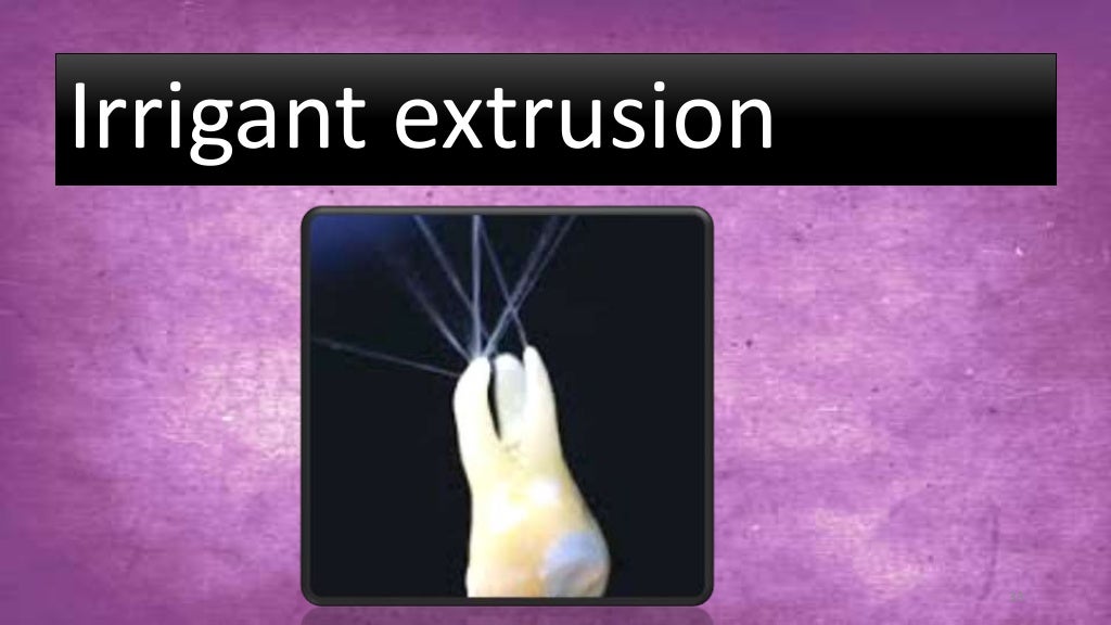 Sodium hypochlorite and its use as an endodontic irrigant Australian