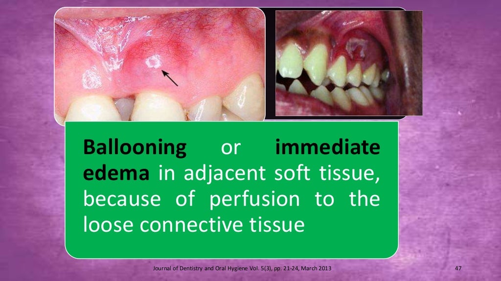 Sodium hypochlorite and its use as an endodontic irrigant Australian