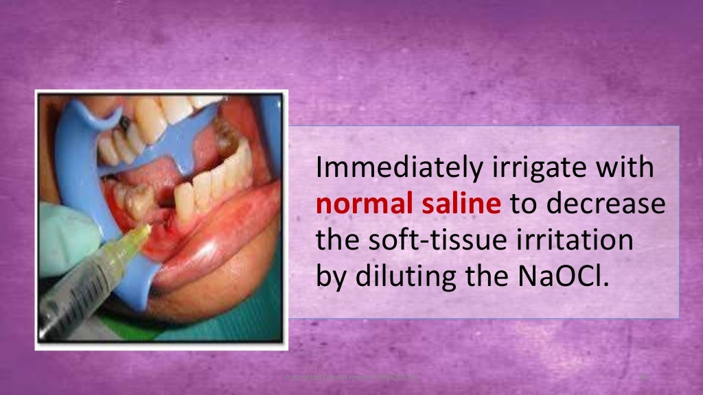 Sodium hypochlorite and its use as an endodontic irrigant Australian