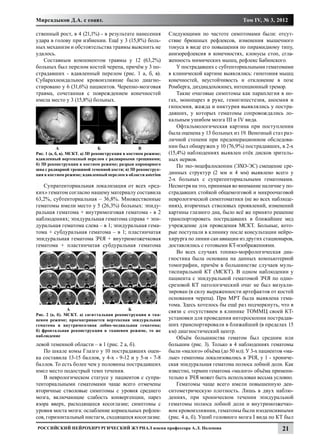 Мирсадыков Д.А. с соавт.                                                                       Том IV, № 3, 2012

ственный рост, в 4 (21,1%) - в результате нанесения             Следующими по частоте симптомами были: отсут-
удара в голову при избиении. Ещё у 3 (15,8%) боль-              ствие брюшных рефлексов, изменения мышечного
ных механизм и обстоятельства травмы выяснить не                тонуса в виде его повышения по пирамидному типу,
удалось.                                                        анизорефлексия в конечностях, клонусы стоп, сгла-
   Составным компонентом травмы у 12 (63,2%)                    женность мимических мышц, рефлекс Бабинского.
больных был перелом костей черепа, причём у 3 по-                   У пострадавших с субтенториальными гематомами
страдавших - вдавленный перелом (рис. 1 а, б, в).               в клинической картине выявлялись: гипотония мышц
Субарахноидальное кровоизлияние было диагно-                    конечностей, неустойчивость и отклонение в позе
стировано у 6 (31,6%) пациентов. Черепно-мозговая               Ромберга, диздиадохокинез, интенционный тремор.
травма, сочетанная с повреждением конечностей                       Такие очаговые симптомы как параплегия в но-
имела место у 3 (15,8%) больных.                                гах, монопарез в руке, гемигипестезия, аносмия и
                                                                гипосмия, жажда и никтурия выявлялись у постра-
                                                                давших, у которых гематомы сопровождались ло-
                                                                кальным ушибом мозга III и IV вида.
                                                                    Офтальмологическая картина при поступлении
                                                                была оценена у 13 больных из 19. Венозный стаз раз-
                                                                личной степени при предоперационном обследова-
	А		                             Б		               В            нии был обнаружен у 10 (76,9%) пострадавших, в 2-х
Рис. 1 (а, б, в). МСКТ. а) 3D реконструкция в костном режиме;   (15,4%) наблюдениях выявлен отёк дисков зритель-
вдавленный вертексный перелом с радиарными трещинами;           ных нервов.
б) 3D реконструкция в костном режиме; разрыв коронарного            По эхо-энцефалоскопии (ЭХО-ЭС) смещение сре-
шва с радиарной трещиной теменной кости; в) 3D реконструк-
ция в костном режиме; вдавленный перелом в области asterion     динных структур (2 мм и 4 мм) выявлено всего у
                                                                2-х больных с супратенториальными гематомами.
   Супратенториальная локализация от всех «ред-                 Несмотря на это, принимая во внимание наличие у по-
ких» гематом согласно нашему материалу составила                страдавших стойкой общемозговой и микроочаговой
63,2%, субтенториальная – 36,8%. Множественные                  неврологической симптоматики (не во всех наблюде-
гематомы имели место у 5 (26,3%) больных: эпиду-                ниях), вторичных стволовых проявлений, изменений
ральная гематома + внутримозговая гематома - в 2                картины глазного дна, было всё же принято решение
наблюдениях; эпидуральная гематома справа + эпи-                транспортировать пострадавших в ближайшее мед
дуральная гематома слева – в 1; эпидуральная гема-              учреждение для проведения МСКТ. Больные, кото-
тома + субдуральная гематома – в 1; пластинчатая                рые поступали в клинику после консультации нейро-
эпидуральная гематома ЗЧЯ + внутримозжечковая                   хирурга по линии сан авиации из других стационаров,
гематома + пластинчатая субдуральная гематома                   доставлялись с готовыми КТ-изображениями.
                                                                    Во всех случаях топико-морфологическая диа-
                                                                гностика была основана на данных компьютерной
                                                                томографии, причём в большинстве случаев муль-
                                                                тиспиральной КТ (МСКТ). В одном наблюдении у
                                                                пациента с эпидуральной гематомой ЗЧЯ по одно-
                                                                срезовой КТ патологический очаг не был визуали-
                                                                зирован (в силу выраженности артефактов от костей
                                                                основания черепа). При МРТ была выявлена гема-
                                                                тома. Здесь хотелось бы ещё раз подчеркнуть, что в
	               А			                       Б
                                                                связи с отсутствием в клинике ТОММЦ своей КТ-
Рис. 2 (а, б). МСКТ. а) сагиттальная реконструкция в тка-
невом режиме; просматривается вертексная эпидуральная           установки для проведения интероскопии пострадав-
гематома и внутримозговая лобно-медиальная гематома;            ших транспортировали в ближайший (в пределах 15
б) фронтальная реконструкция в тканевом режиме, то же           км) диагностический центр.
наблюдение
                                                                    Объём большинства гематом был средним или
левой теменной области – в 1 (рис. 2 а, б).                     большим (рис. 3). Только в 4 наблюдениях гематомы
   По шкале комы Глазго у 10 пострадавших оцен-                 были «малого» объёма (до 50 мл). У 3-х пациентов «ма-
ка составила 13-15 баллов, у 4-х - 9-12 и у 5-и - 7-8           лые» гематомы локализовались в ЗЧЯ, у 1 - хрониче-
баллов. То есть более чем у половины пострадавших               ская эпидуральная гематома полюса лобной доли. Как
имел место подострый темп течения.                              известно, термин гематома «малого» объёма примени-
   В неврологическом статусе у пациентов с супра-               тельно к ЗЧЯ может быть использован весьма условно.
тенториальными гематомами чаще всего отмечены                       Гематомы чаще всего имели повышенную ден-
вторичные стволовые симптомы с уровня среднего                  ситометрическую плотность. Лишь в двух наблю-
мозга, включающие слабость конвергенции, парез                  дениях, при хроническом течении эпидуральной
взора вверх, расходящееся косоглазие; симптомы с                гематомы полюса лобной доли и внутримозжечко-
уровня моста мозга: ослабление корнеальных рефлек-              вом кровоизлиянии, гематомы были изоденсивными
сов, горизонтальный нистагм, сходящееся косоглазие.             (рис. 4 а, б). Ушиб головного мозга I вида по КТ был
Российский нейрохирургический журнал имени профессора А.Л. Поленова                                             21
 