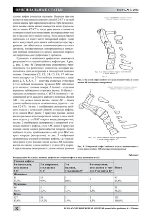 Оригинальные статьи                                                                         Том IV, № 3, 2012

случае кифоз считается нулевым. Важным фактом
является взаиморасположение линий С2-С7 и осевой
линии аксиса при нарастании кифоза. При резком ки-
фозе осевая линия аксиса смещается назад (дорзаль-
но) за линию С2-С7 и тогда угол аксиса становится
отрицательным или минусовым, но определяется так
же в градусах и со знаком минус. Угол аксиса открыт
дорзально, т.е имеет место минусовый кифоз. Чаще
всего минусовый угол аксиса наблюдается при двух
уровнях нестабильности позвоночно-двигательного
сегмента, множественных компрессионных перело-
мах шейных позвонков и в далеко зашедших формах
дегенеративно-дистрофического процесса.
    Сущность изложенного графически поясняется
рисунками 4-х степеней шейного кифоза (рис. 1, рис.
2, рис. 3, рис. 4). Представлены скиаграммы рент-
генограмм 4-х различных пациентов, которым вы-
полнялись спондилограммы в стандартной позиции
головы. Символами С2, С3, С4, С5, С6, С7 обозна-
чены контуры тел 2-7-го шейных позвонков, а циф-
                                                          Рис. 3. Нулевой кифоз шейного отдела позвоночника с углом
рами 2, 3, 4, 5, 6, 7 – контуры остистых отростков
                                                          аксиса 00 (схема рентгенограммы)
2-7-го шейных позвонков. Буквами ВАС обозначен
угол аксиса с точками замера: А (апекс) – середина
вершины зубовидного отростка аксиса, В (базис) –
середина основания аксиса, С (С7-й позвонок) – за-
дненижний угол седьмого шейного позвонка. Линия
АВ – это осевая линия аксиса, линия АС – линия
длины шейного отдела позвоночника, (кратко – ли-
ния С2-С7). На рис. 1 изображена скиаграмма шей-
ного отдела с начальной (лёгкой) степенью кифоза,
угол аксиса ВАС равен 7 градусам (осевая линия
аксиса располагается впереди от линии длины шей-
ного отдела, угол ВАС открыт вперед (вентрально);
на рис. 2 изображена скиаграмма с умеренной сте-
пенью шейного кифоза, угол ВАС равен 4 градусам
(осевая линия аксиса располагается впереди линии
шейного отдела, приближается к ней, угол ВАС от-
крыт кпереди (вентрально); на рис. 3 изображена
скиаграмма с нулевой степенью кифоза, т.е. угол ак-
сиса равен нулю (осевая линия аксиса АВ наклады-
вается на линию длины шейного отдела АС); на рис.         Рис. 4. Минусовый кифоз шейного отдела позвоночника с
4 представлена скиаграмма с углом аксиса равным           углом аксиса минус 120 (схема рентгенограммы)

                                                                                                         Таблица 1
Распределение больных с шейным кифозом по степени кифоза и полу пациентов n=152
Степени кифоза
1-я начальная,          2-я умеренная,         3-я                    4-я минусовая,
угол аксиса             угол аксиса            нулевая,               угол аксиса от ми- Итого
9-60                    5-10                   угол аксиса 00         нус 10 до минус 130
Женщины
81                      15                     1                                            97
                                                                      0
53,3%                   9,9%                   0,6%                                         63,8%
Мужчины
46                      5                      2                      2                     55
30,3%                   3,3%                   1,3%                   1,3%                  36,2%
Всего
127                     20                     3                      2                     152
83,6%                   13,2%                  1,9%                   1,3%                  100,0%


  32                                          Russian Neurosurgical Journal named after professor A.L. Polenov
 