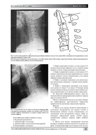 Пустовойтенко В.Т. с соавт.                                                                    Том IV, № 3, 2012




			                            А						                                                    Б
Рис 7. а) Тот же больной К-ч. Максимальное разгибание шейного отдела. Угол аксиса ВАС уменьшается по сравнению со стан-
дартной позицией до минус 2,40
б) Схема рентгенограммы того же больного. Угол ВАС равен минус 2,40, открыт дорзально. Осевая линия аксиса располага-
ется за линией длины шейного отдела позвоночника



                                                                  1. Кифоз начальной степени с углом аксиса 9-10
                                                               (осевая линия аксиса образует угол с линией длины
                                                               шейного отдела, открытым вперед (вентрально);
                                                                  2. Кифоз умеренной степени с углом аксиса 5-10,
                                                               (осевая линия аксиса больше приближается к линии
                                                               длины шейного отдела позвоночника, угол аксиса
                                                               обращен вперед (вентрально);
                                                                  3. Кифоз с нулевым значением угла аксиса (осе-
                                                               вая линия аксиса совпадает с линией длины шейно-
                                                               го отдела);
                                                                  4. Кифоз с минусовым значением угла аксиса,
                                                               угол аксиса от минус 10 до минус 130 (осевая линия
                                                               аксиса смещается назад за линию длины шейного от-
                                                               дела позвоночника, угол аксиса открыт дорзально).
                                                                  III. Локальное кифозирование одного –двух по-
                                                               звонков (обычно при выпрямлении шейного лордоза
                                                               при угле аксиса 10-120).
                                                                  Область применения метода угла аксиса обшир-
                                                               на: нейрохирургия, рентгенология, неврология,
                                                               травматология, ортопедия, мануальная терапия.
                                                                  Выводы:
                                                                  1. Метод угла аксиса является объективным и
Рис. 8. Больной К-ч 75 лет, через 2 года после операции. При   наглядным инструментом для оценки статики и
стандартном положении головы угол аксиса плюс 5,70 (1-я
                                                               биомеханики шейного отдела позвоночника, по-
степень кифоза) уменьшился в лучшую сторону (была 4-я
степень кифоза)                                                зволяющим четко разграничить между собой ги-
                                                               перлордоз, нормальный лордоз, легкий лордоз,
   Классификация кифоза шейного отдела                         выпрямление шейного лордоза, кифоз шейного
   I. По распространенности:                                   отдела.
   1. шейный кифоз тотальный;                                     2. Метод угла аксиса, защищенный патентом
   2. шейный кифоз локальный (сегментарный).                   Беларуси, впервые позволил выделить 4 степени ки-
   II. По размерам угла аксиса:                                фоза: 1) начальный кифоз (угол аксиса 9-60), 2) уме-
Российский нейрохирургический журнал имени профессора А.Л. Поленова                                              35
 