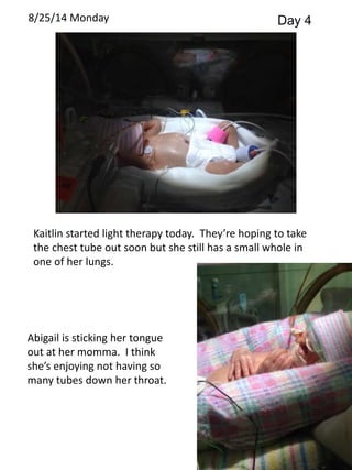 8/25/14 Monday Day 4 
Kaitlin started light therapy today. They’re hoping to take 
the chest tube out soon but she still has a small whole in 
one of her lungs. 
Abigail is sticking her tongue 
out at her momma. I think 
she’s enjoying not having so 
many tubes down her throat. 
 