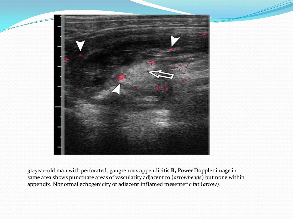 Ultrasound imaging of Bowel pathology