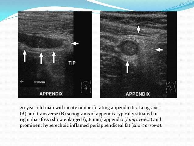 Ultrasound imaging of Bowel pathology
