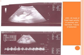 USG –M mode of
Fetal heart activity
In awomen who
had blunt Trauna
of abdomen

 