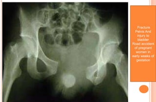 Fracture
Pelvis And
injury to
bladder
Road accident
of pregnant
women in
early weeks of
gestation

 