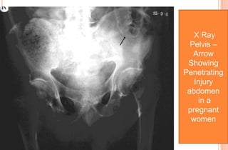 X Ray
Pelvis –
Arrow
Showing
Penetrating
Injury
abdomen
in a
pregnant
women

 